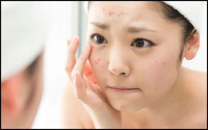 Các loại mụn trên khuôn mặt