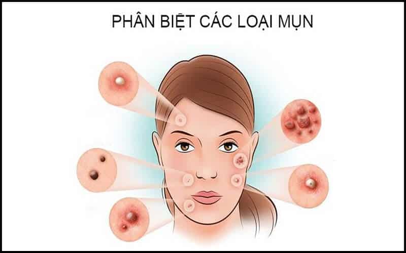 Các loại mụn ở mặt
