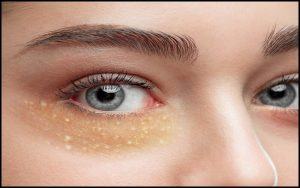 Cách trị mụn thịt