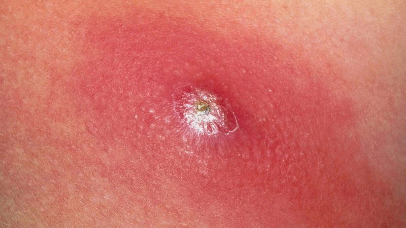 Mụn nhọt là một trong các loại mụn trên mặt