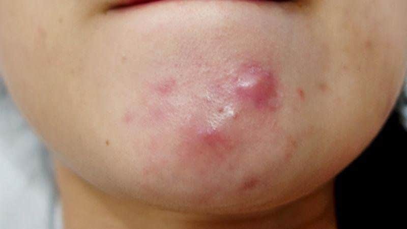 mụn nang là những vết mụn lớn gây đau