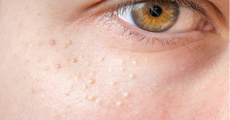 mụn thịt là các u nang nhỏ lành tính