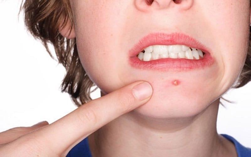 Cách trị mụn bọc