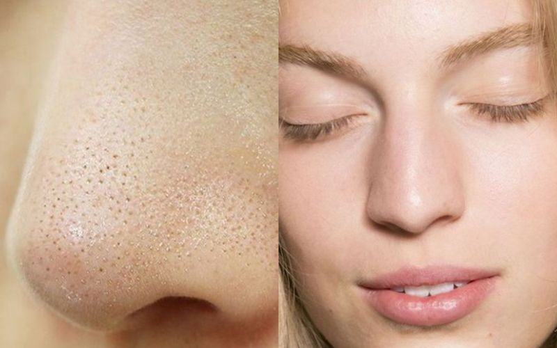 cách trị mụn cám