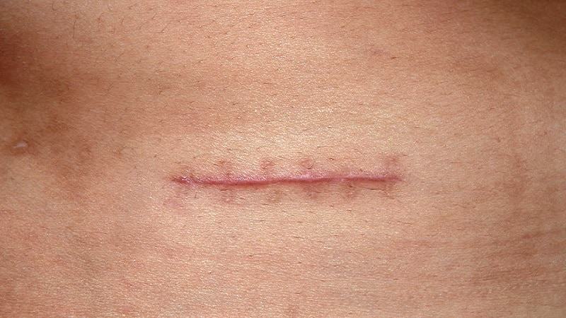 Thuốc trị sẹo Strataderm có tốt không 