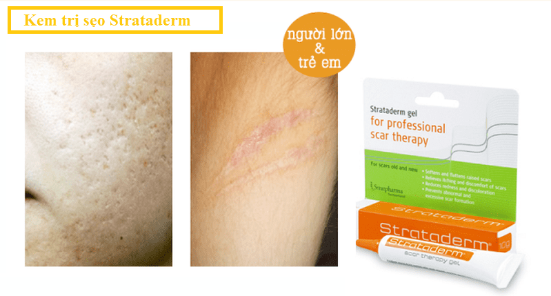 Tất cả mọi người đều có thể sử dụng thuốc trị sẹo Strataderm