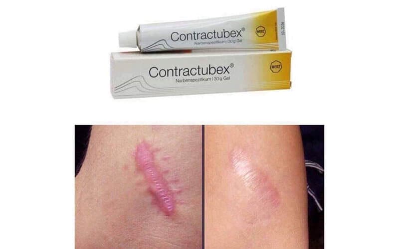 Công dụng kem trị sẹo contractubex
