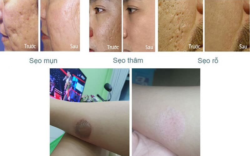 công dụng kem trị sẹo scar esthetique