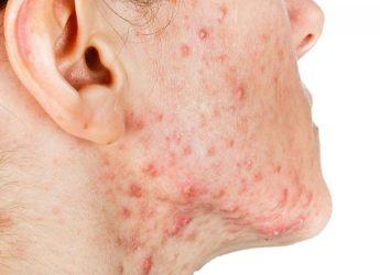 mụn nội tiết nên uống gì