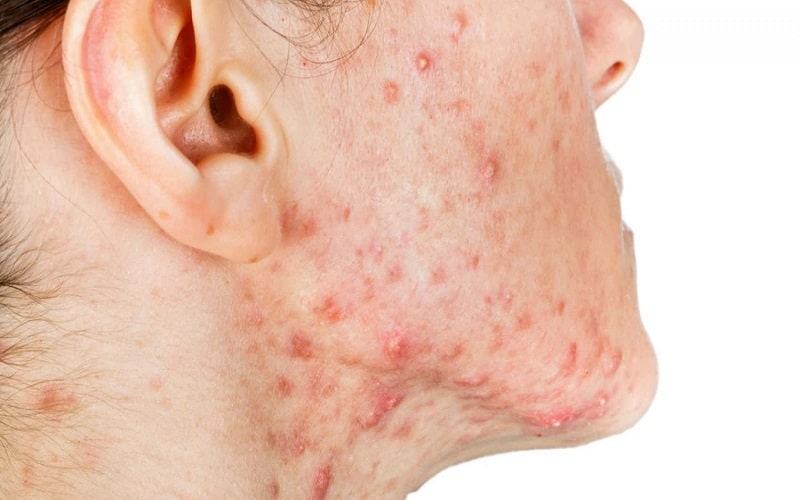 mụn nội tiết nên uống gì