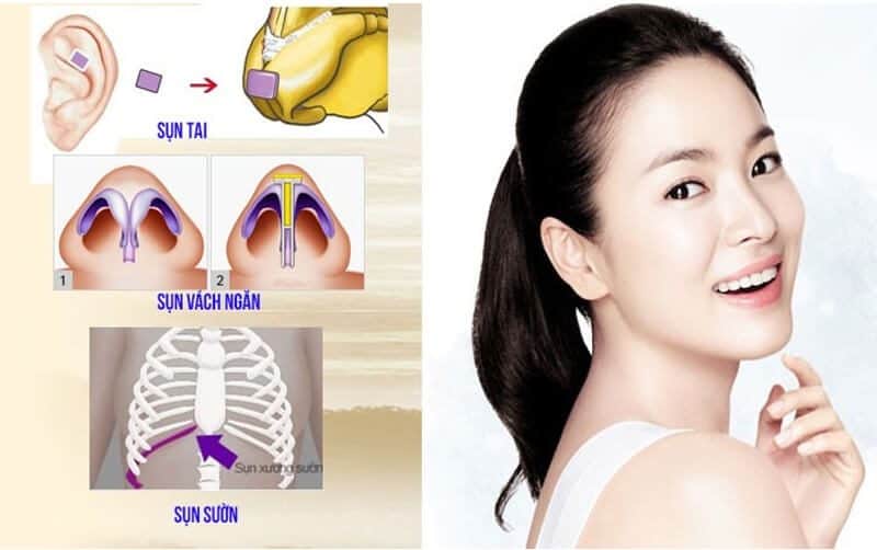 Quy trình nâng mũi bán cấu trúc là gì?