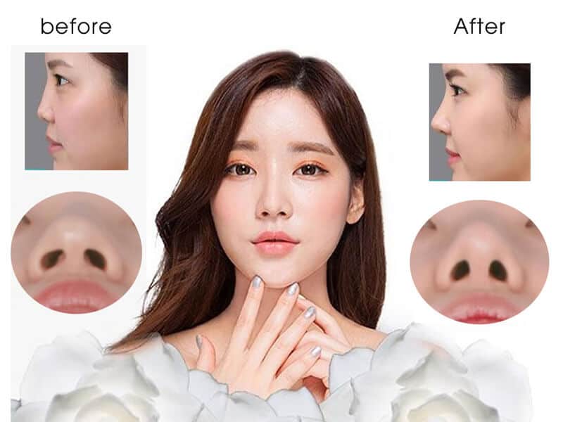 nâng mũi bán cấu trúc là gì có nên thực hiện không