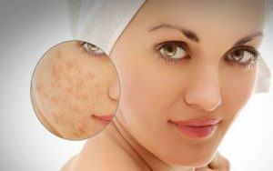 Thuốc trị sẹo thâm