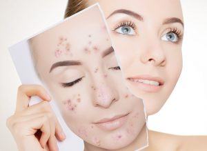 Thuốc trị sẹo thủy đậu được bác sĩ khuyên dùng