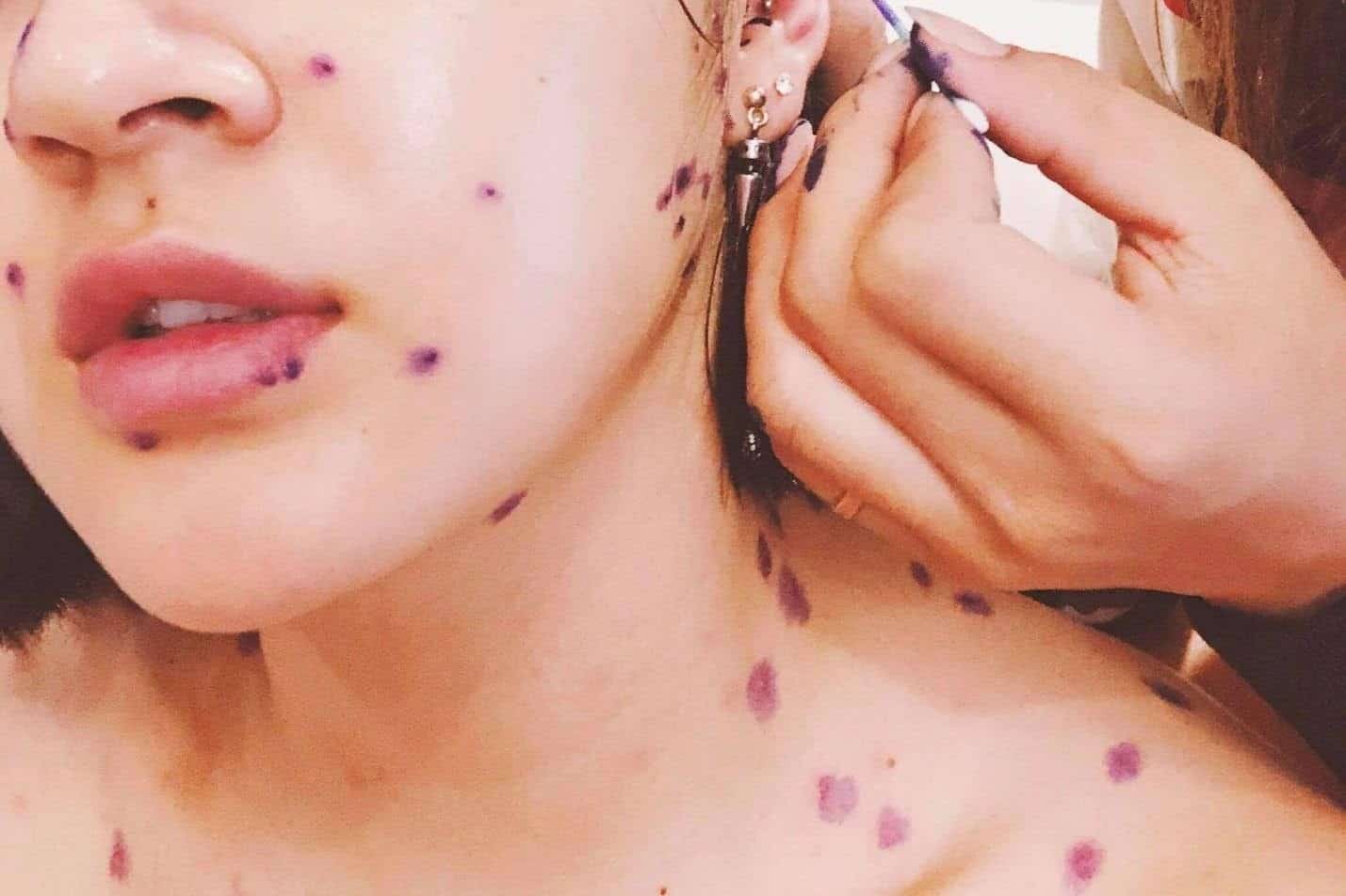 Trị sẹo thủy đậu