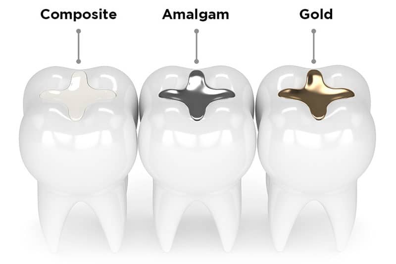 Các vật liệu tám răng