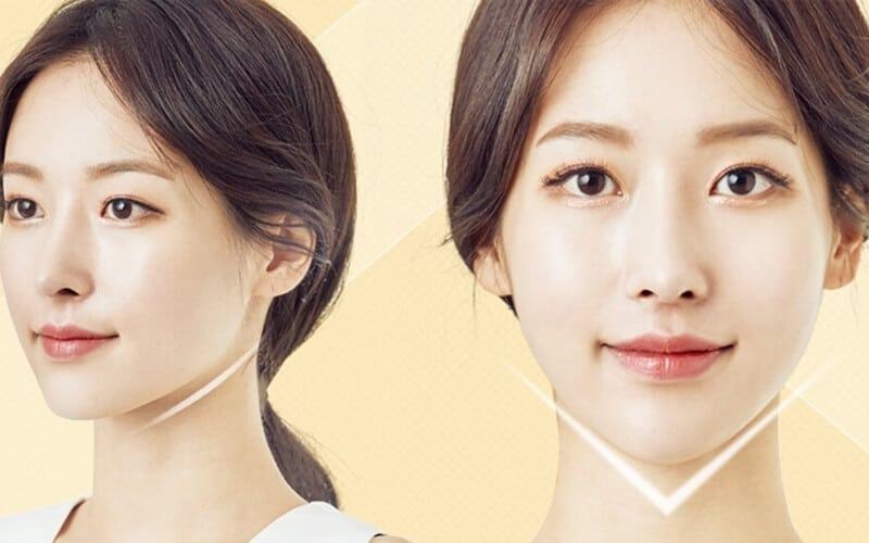 Cằm v line góc thẳng