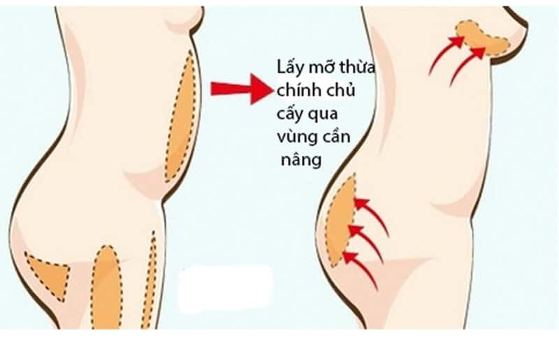 Nâng ngực bằng mỡ tự thân
