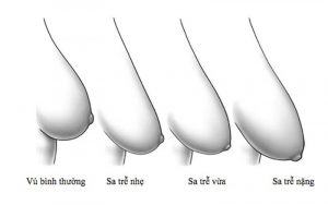 Ngực xệ là gì?