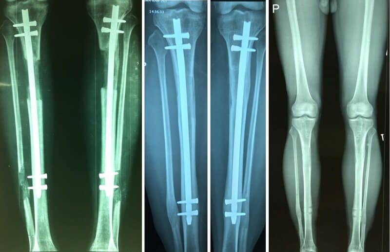 Phẫu thuật tăng chiều cao 