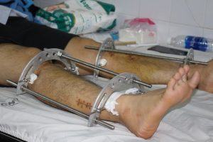 Khái niệm phẫu thuật tăng chiều cao?