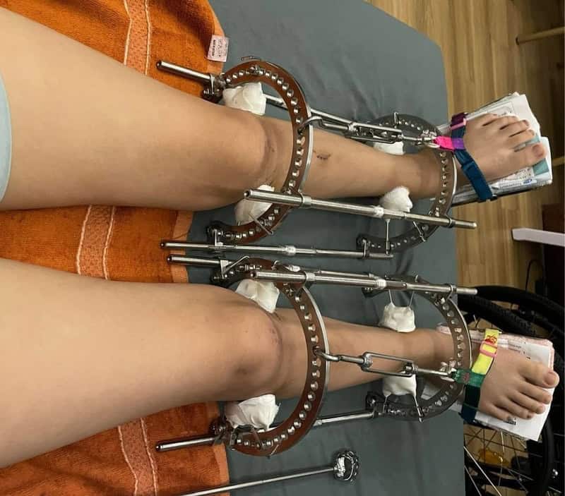 Xương hồi phục quá chậm sau phẫu thuật